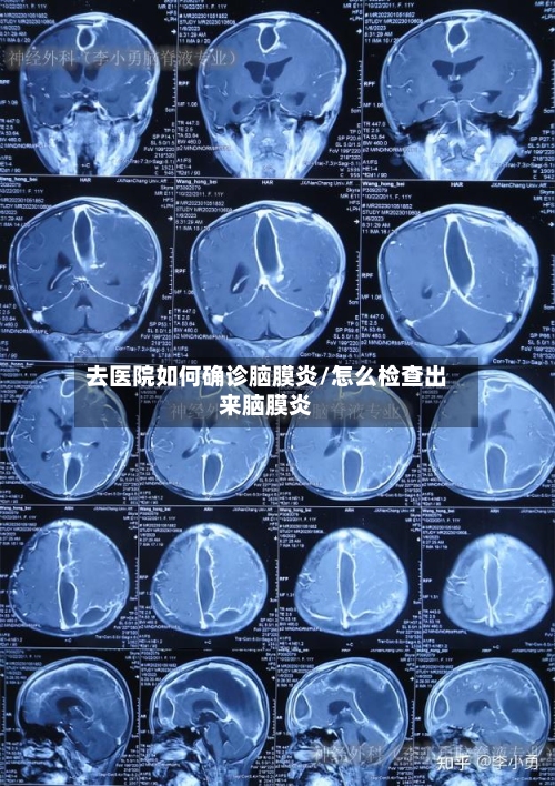 去医院如何确诊脑膜炎/怎么检查出来脑膜炎-第1张图片