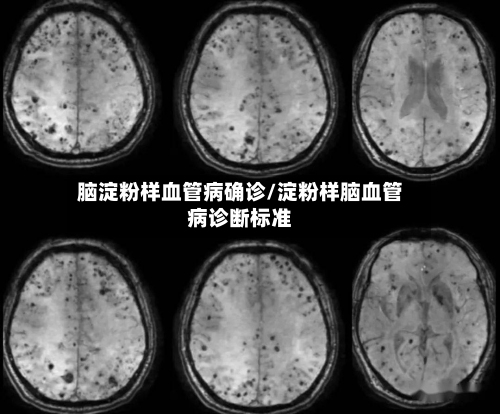 脑淀粉样血管病确诊/淀粉样脑血管病诊断标准-第1张图片