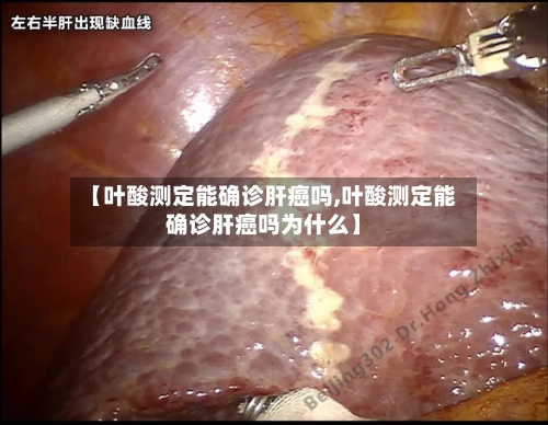 【叶酸测定能确诊肝癌吗,叶酸测定能确诊肝癌吗为什么】-第1张图片