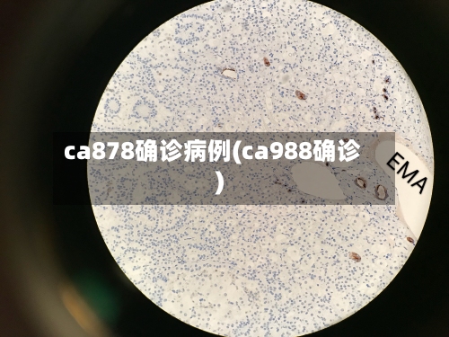 ca878确诊病例(ca988确诊)-第1张图片
